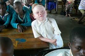 Persecución de  albinos en África: los eurodiputados piden un alto a la impunidad