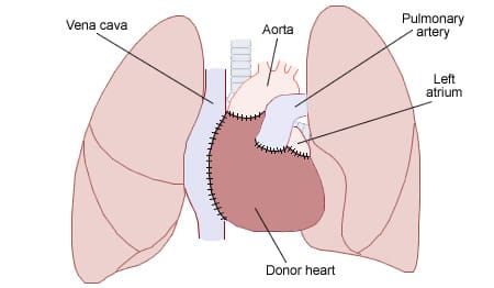 El medico autodidacta sudafricano que trasplantó el primer corazón y fue ignorado por negro